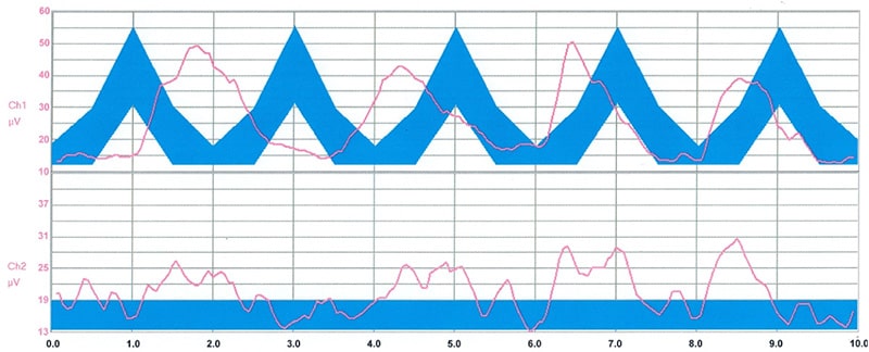 Rapid Squeeze contraction